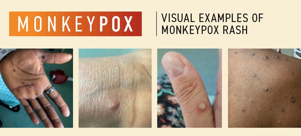 The World Health Organization (WHO) continues to work with patients and community advocates to develop and deliver information tailored to communities affected by monkeypox. The World Health Organization (WHO) continues to work with patients and community advocates to develop and deliver information tailored to communities affected by monkeypox.
