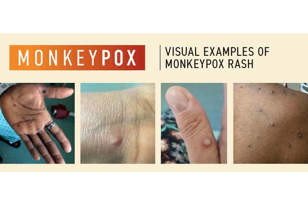 Emergency Committee meets again as Monkeypox cases pass 14,000: WHO | UN News