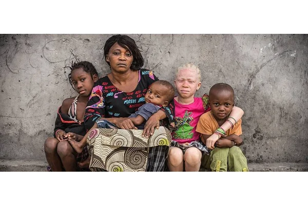 Making education safe for children with albinism in Malawi | UN News