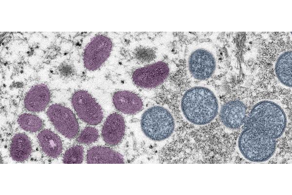 Monkeypox declared a global health emergency by the World Health Organization | UN News