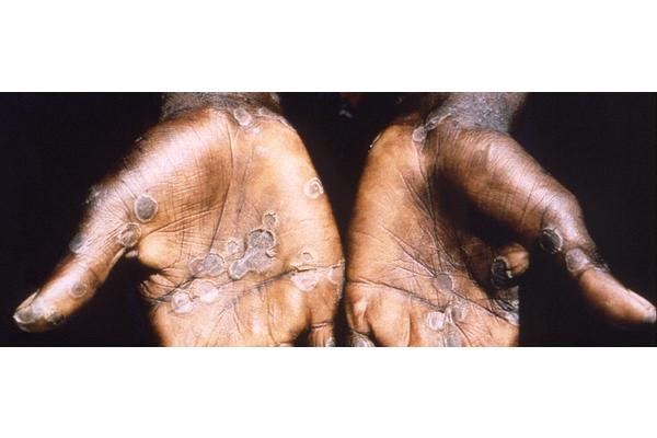 Monkeypox: How it spreads, who’s at risk