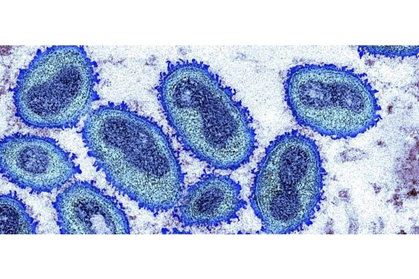 Monkeypox not presently a global public health emergency: WHO | UN News