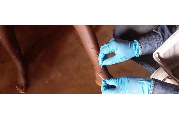 Mpox: What you need to know about the latest public health emergency | UN News