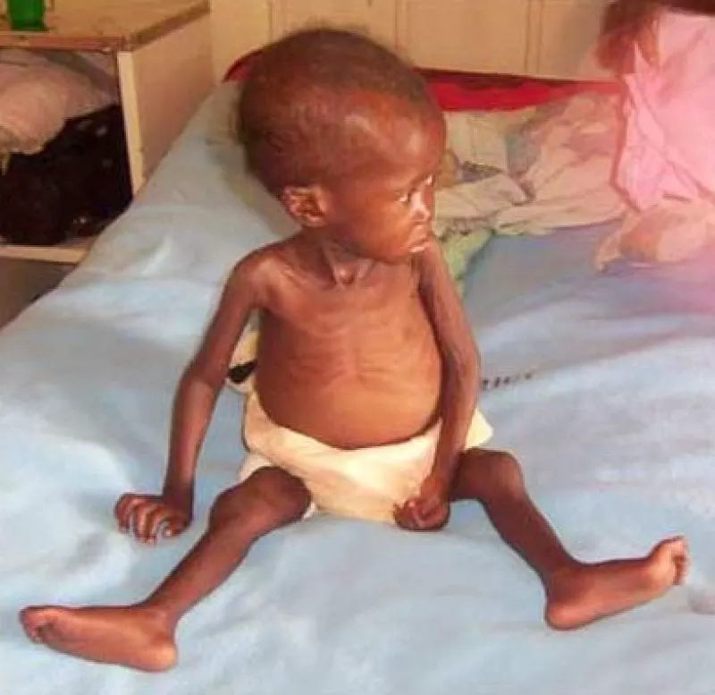 Malnourished_child
