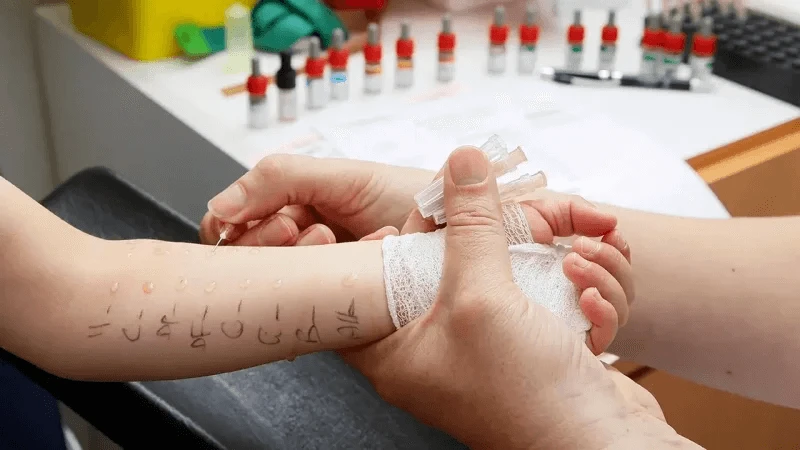 A child undergoes testing for food allergies, which a new study suggests are driven by overactive immune cells in the blood. Credit: BSIP SA via Alamy