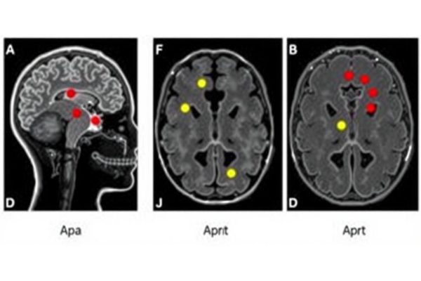 Revolutionary AI Identifies Hidden Brain Abnormalities in Epileptic Children