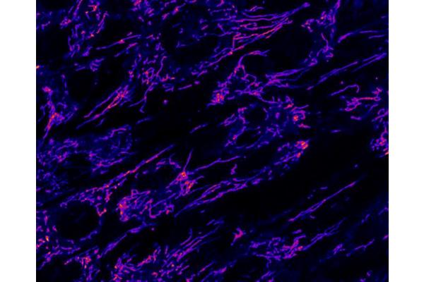 Rare Childhood Metabolic Crises Explained by Fat Transport Deficiency