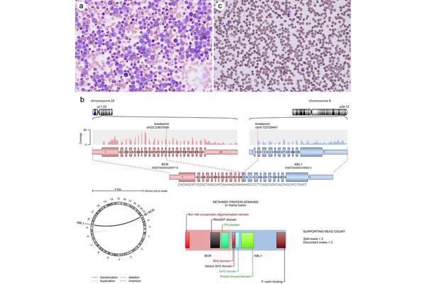 Exploring the Role of Molecular Genetic Testing in Hematopoietic and Lymphatic Neoplasms