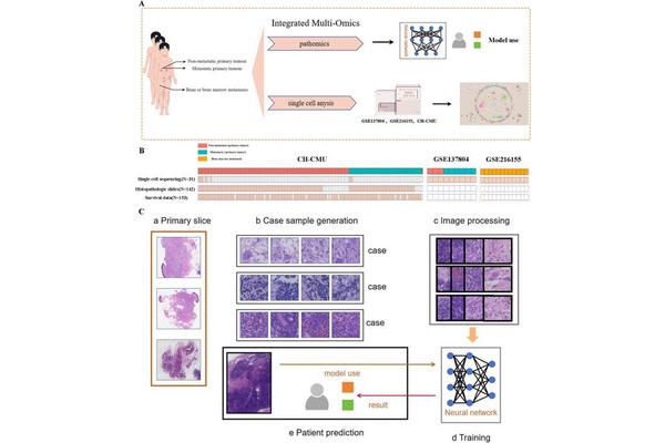 Revolutionary AI Innovations Enhance Neuroblastoma Diagnosis and Predict Bone/Bone Marrow Metastasis