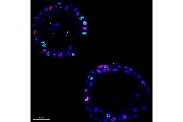 Unveiling the Hidden DNA Circles Driving the Aggressiveness of Pancreatic Cancer