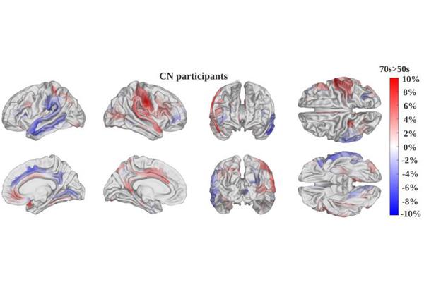 Revolutionary AI Model Reveals Insights into the Rate of Brain Aging