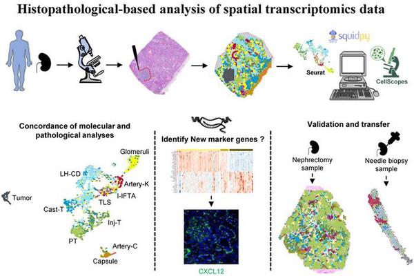Breakthrough Technology Revolutionizes Our Understanding of Kidney Lesions at the Cellular and Molecular Levels