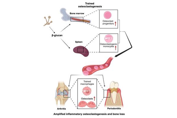 Innate Immune Training: A Catalyst for Increased Inflammatory Bone Loss