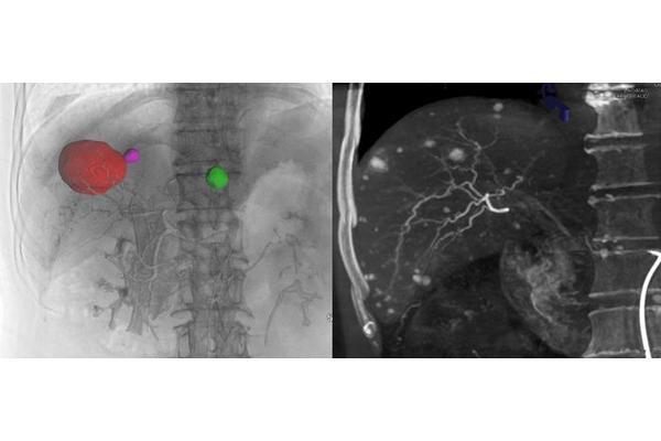 Experts Reach Consensus on Cone-Beam CT Utilization in Interventional Liver Cancer Treatments