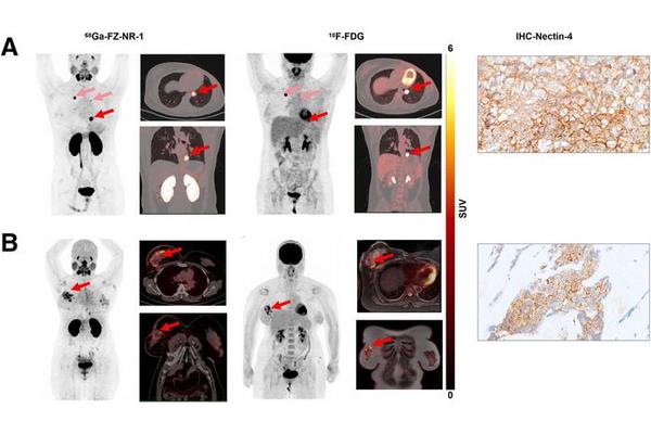 New Radiotracer Uncovers Biomarker Associated with Triple-Negative Breast Cancer