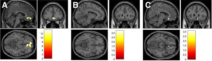 18F-Fallypride PET Imaging