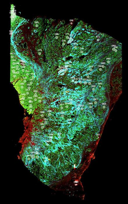 Mapping gastric cancer tumours