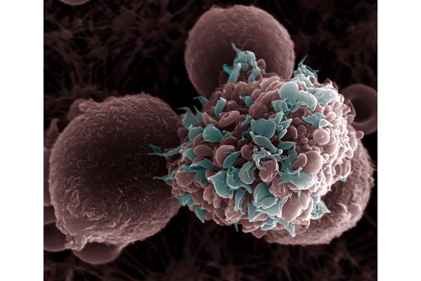 High-Fat Diet Linked to Increased Breast Cancer Metastasis in Animal Studies