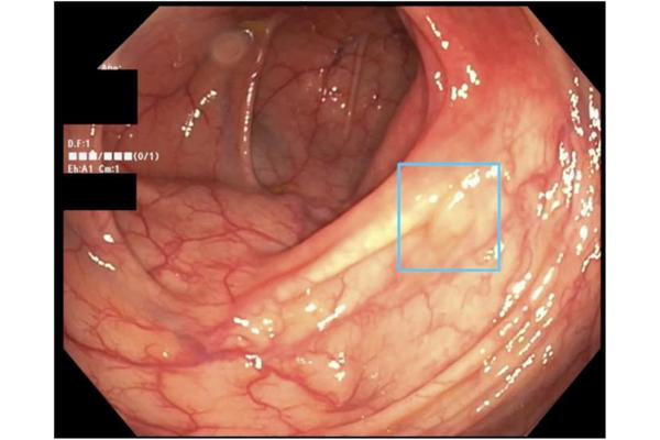 Promising Advances in AI Technology Signal a Future for Colon Cancer Detection