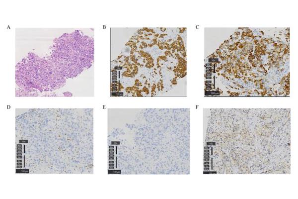 Case Study: Significant Tumor Response in Non-Small Cell Lung Cancer with SMARCA4 Deficiency and Rare EGFR Mutations Following Afatinib Treatment