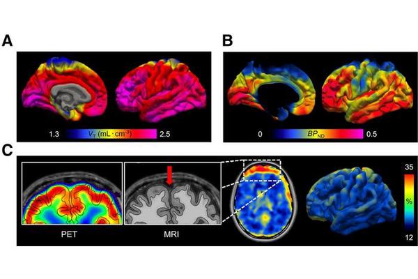 Breakthrough PET Radiotracer Offers Initial Insights into Brain Inflammation Biomarkers