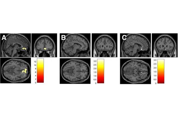 PET Imaging Reveals Direct Role of Dopamine in Enhancing Cognitive Flexibility