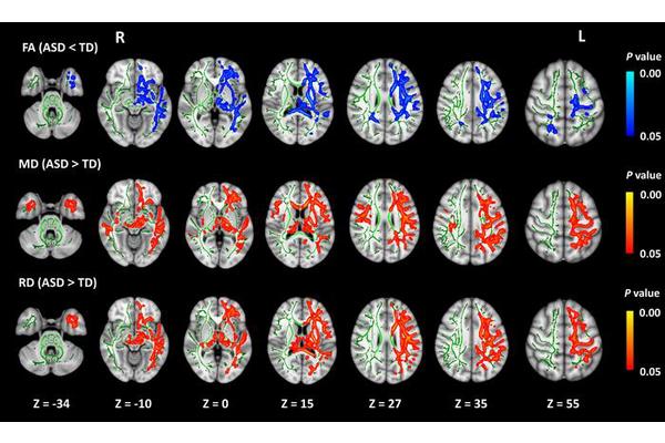 Understanding Autism Through Neuroimaging: The Impact of Brain Connectivity Changes on Symptoms
