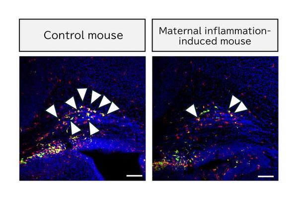 Immune Cell Insights Reveal Link Between Maternal Inflammation and Neurodevelopmental Disorders