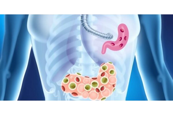 Exploring the Link Between Gallstones, Cholecystectomy, and Cancer Risk: Insights from Observational and Mendelian Randomization Research