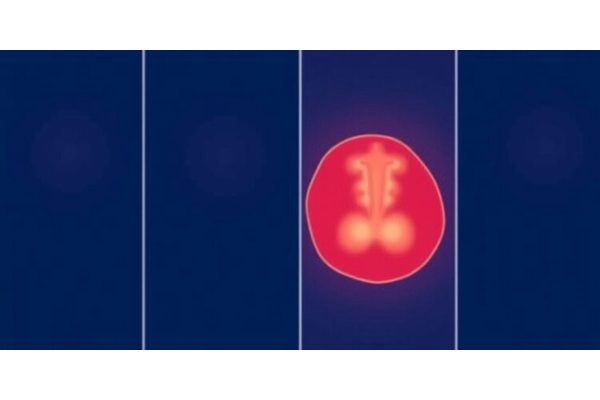 Study Finds Association Between Breast-Conserving Therapy and Breast Shrinkage, According to Plastic and Reconstructive Surgery