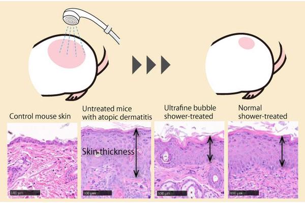 Revolutionary Ultrafine Bubble Showers Show Promise in Treating Atopic Dermatitis