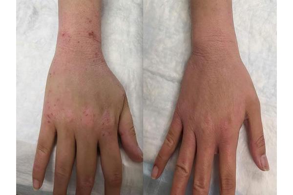 NIH Researchers Establish Diagnostic Criteria for Topical Steroid Withdrawal