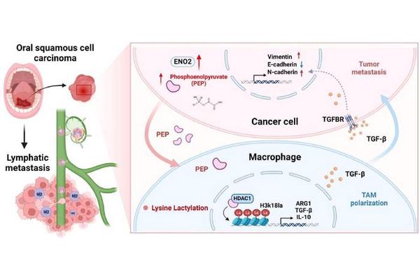 ENO2: A Crucial Contributor to Metastasis in Head and Neck Squamous Cell Carcinoma