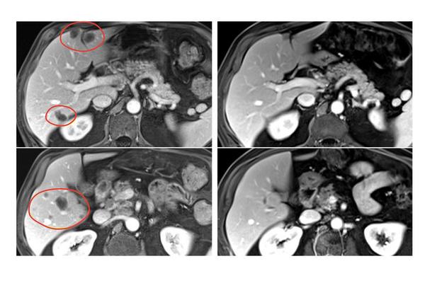 Combination Immunotherapy Demonstrates Efficacy in Reducing Metastatic Gastrointestinal Cancers