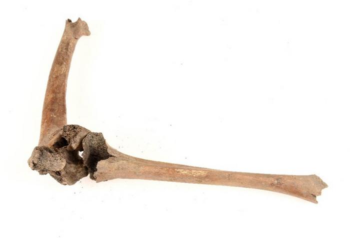 The femoral fracture in grave 2399 with the tibia repositioned to show the 45-degrees angulation.