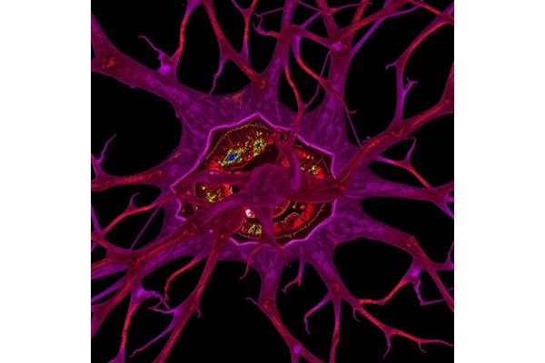 NSUN2 Drives Glycolysis, Immune Evasion in Kidney Cancer