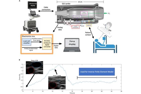 Pilot Study Explores Noninvasive Quantitative Compression Ultrasound for Measuring Central Venous Pressure