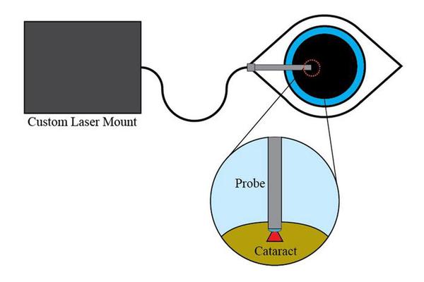 Innovative Low-Cost Laser Method Poised to Revolutionize Global Cataract Surgery Access