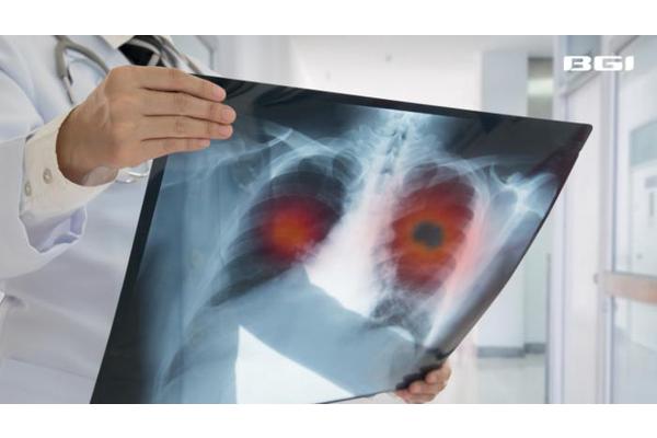 Study Finds DNA Testing Identifies Lung Pathogens Three Times More Effectively Than Traditional Methods