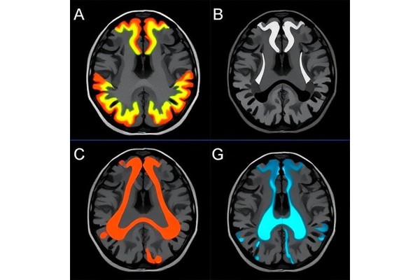 MRI Radiomics Differentiates Chondroid Tumor Grades