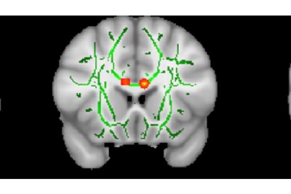 Brain Differences in Children with Conduct Disorder Vary According to Abuse History