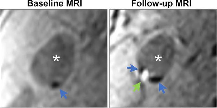Demonstration of colocalization of pre-existing calcification and incident intraplaque hemorrhage in the same plaque.