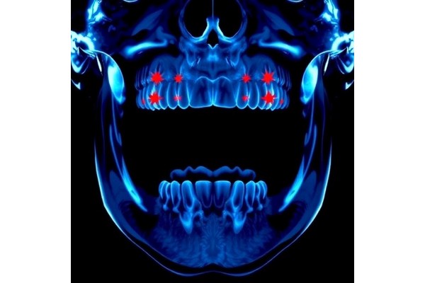 Clinical Signs Predict Prognosis in Oral Cancer