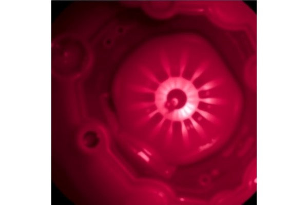 Ten-Year Outcomes of Atypical Small Acinar Hyperplasia