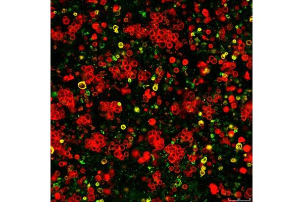 Finnish Researchers Uncover Potential Reasons Behind Breast Cancer’s Variable Response to Immunotherapy