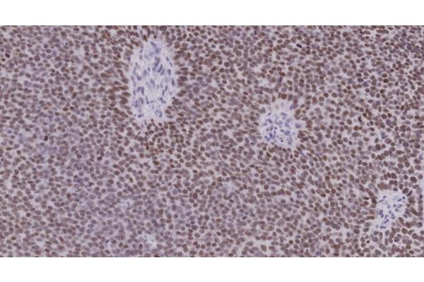 Scientists Identify Early Indicator of Prostate Cancer Aggressiveness