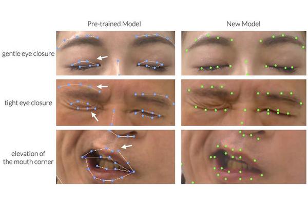 Automated Facial Palsy Assessment Powered by Innovative AI Tool, Reports Plastic and Reconstructive Surgery®