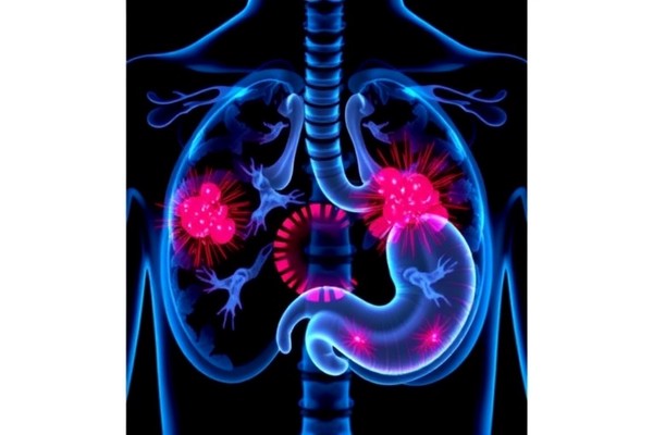 PD-1 Antibody Plus Chemo Boosts Gastric Cancer Treatment