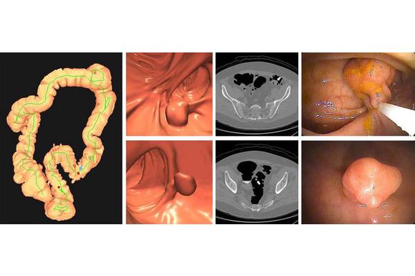 CT colonography outperforms stool DNA testing in colon cancer screening, new study reveals