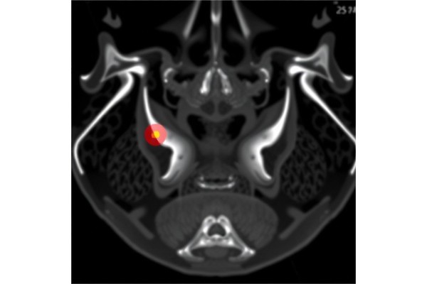 Advanced Cervical Lesion Detection via SEResNet101+SE-VGG19